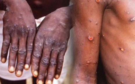 Virus Monkeypox: Akibat Memakan Hewan Terinfeksi, Begini Penjelasan WHO