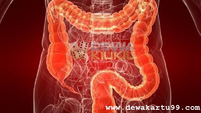 Inflammatory bowel disease atau radang usus