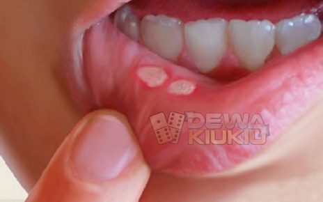 5 Kondisi Ini Normal Terjadi di Rongga Mulut, Jangan Panik!